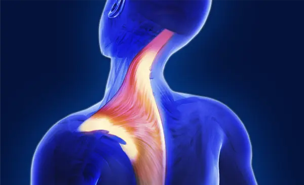 Explore more Cervical Dystonia Patient Support